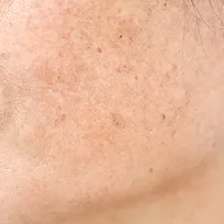Kemisk peeling mot solskador Kemisk peeling mot solskador