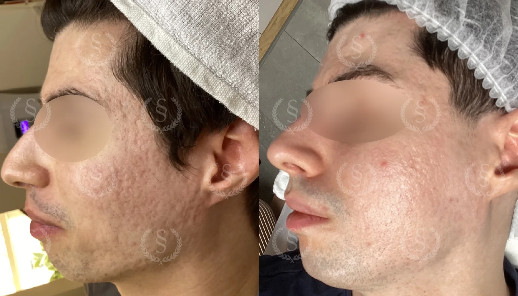 Resultat efter ärrbehandling Ärr i ansiktet före och efter behandling