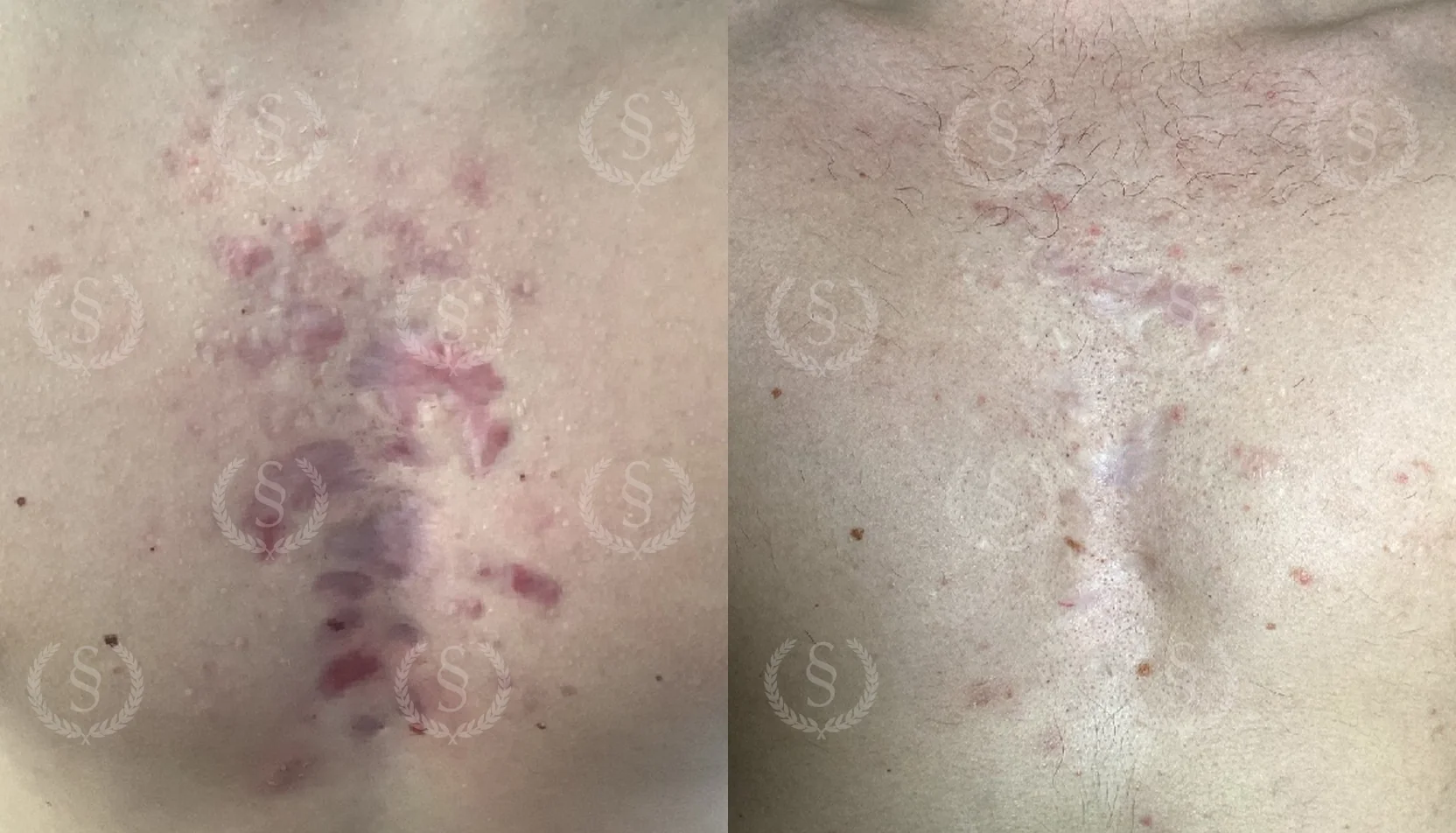 Ärrbehandling på bröstet Ärr på bröstet före och efter behandling