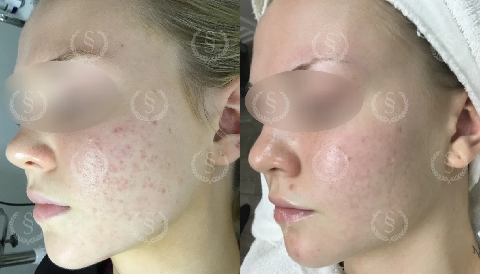 Resultat efter behandling av ärrfläckar Ärrfläckar före och efter behandling