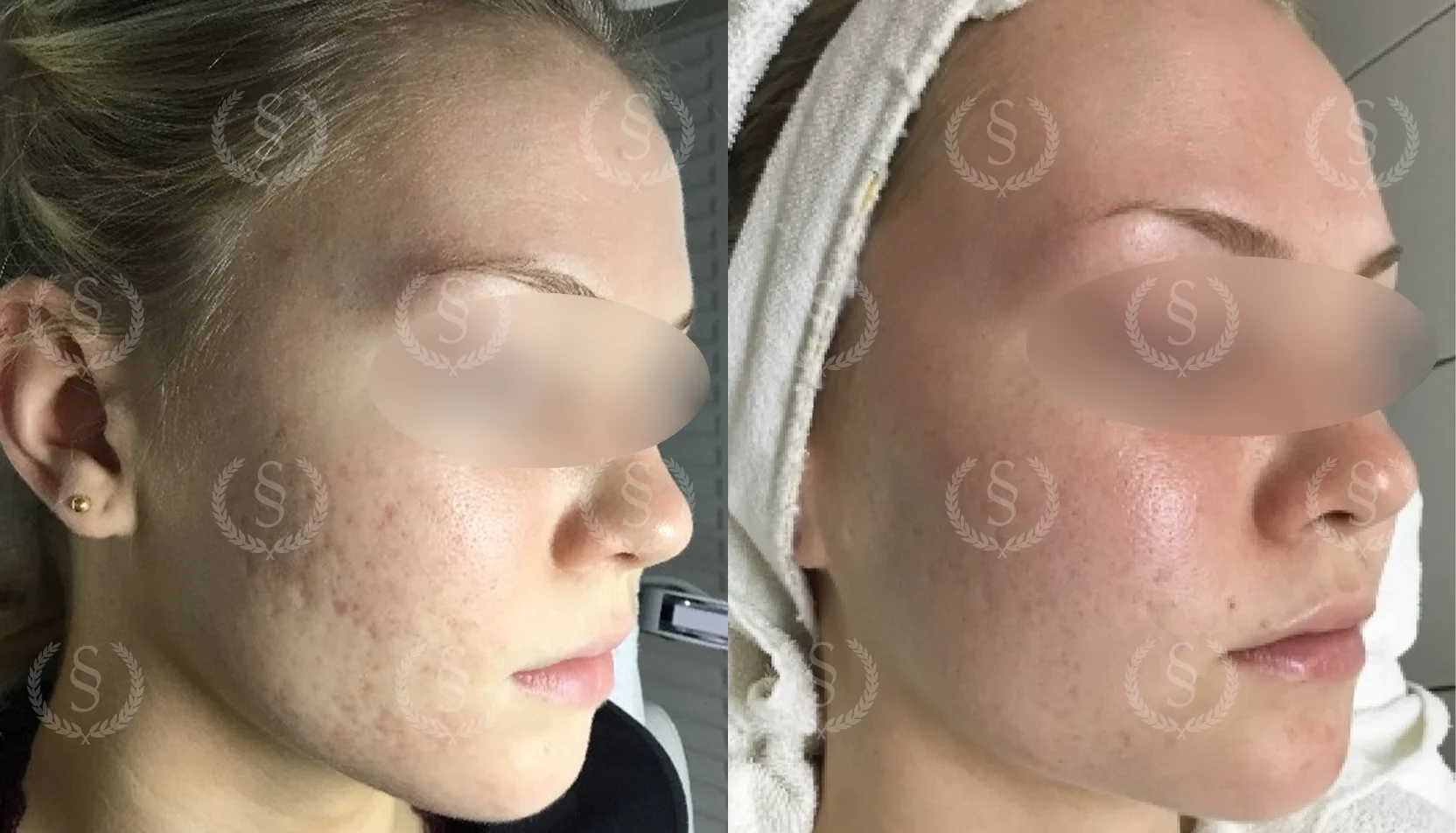 Behandling av gropar och ärr Gropar och ärr före och efter behandling