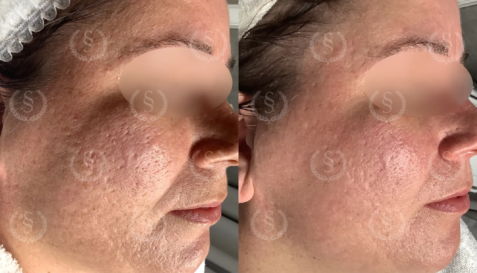 Ärrbehandling på kind Ärr på kind före och efter behandling