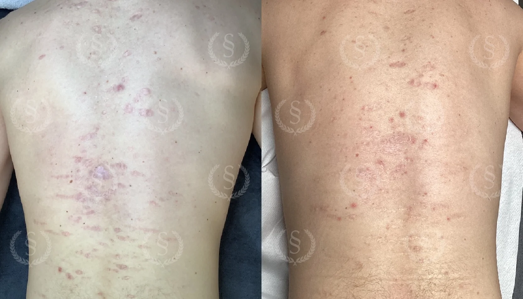 Resultat efter ärrbehandling på ryggen Ärr på ryggen före och efter behandling