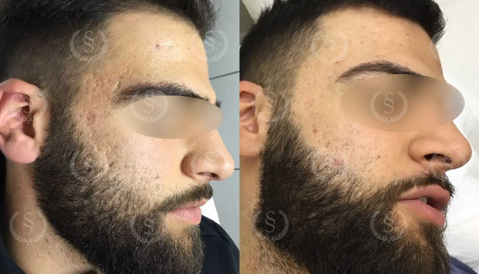 Ärrbehandling på tinning Ärr på tinning hos man före och efter behandling