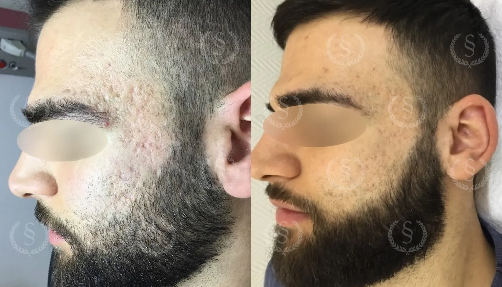 Resultat efter ärrbehandling på tinning Ärr på tinning före och efter behandling