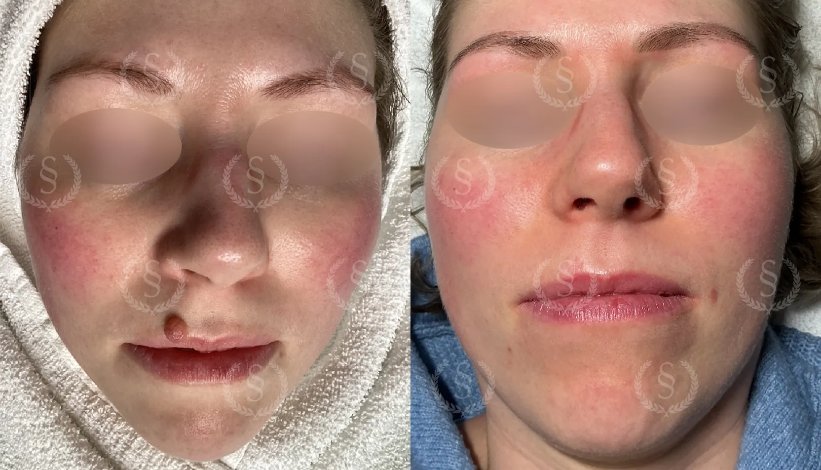 Hudförändring på läppen före och efter behandling