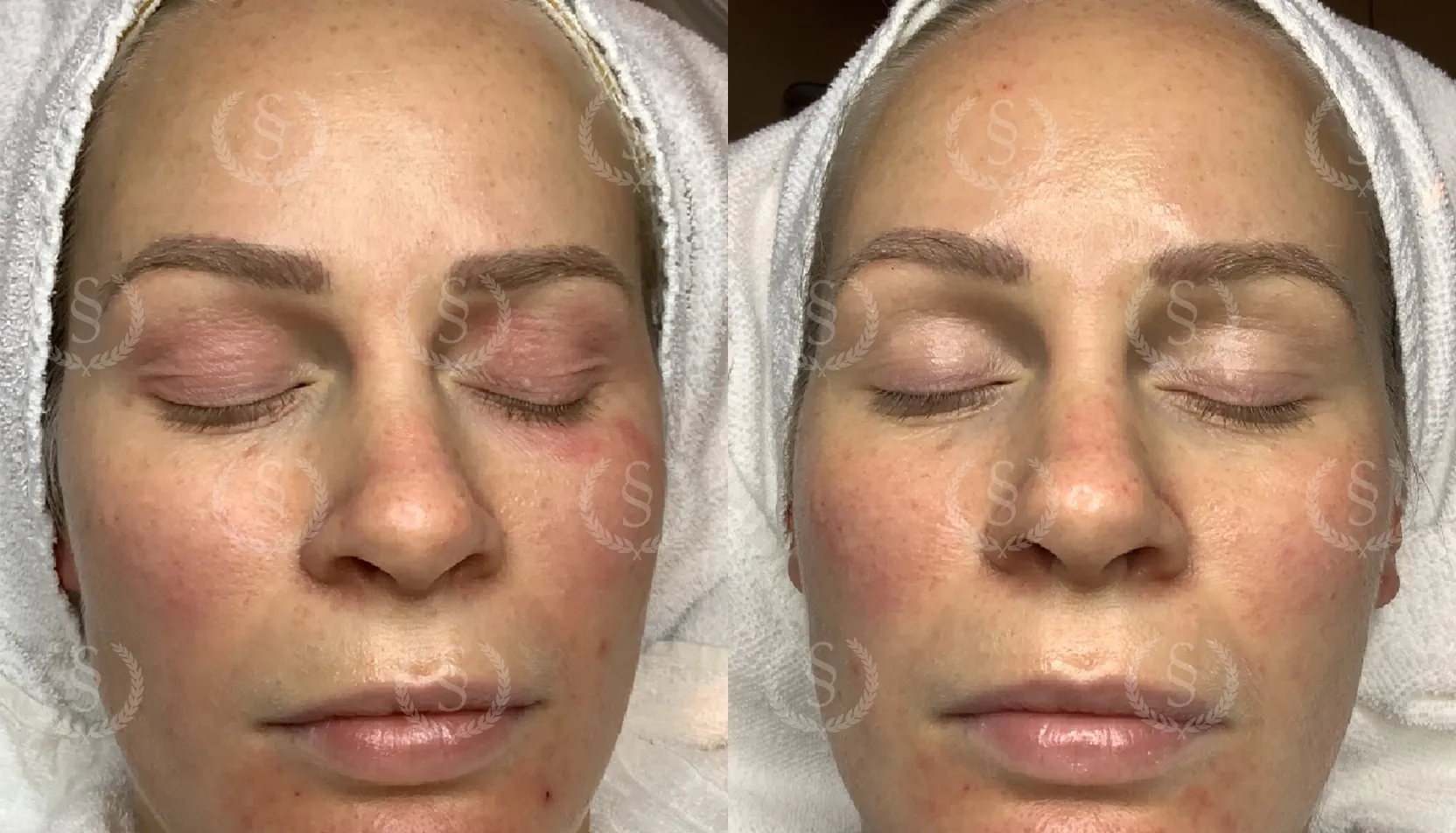 Ögonområdet före och efter Infuzion-behandling