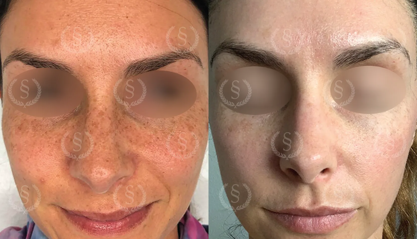 Resultat från behandling av fräknar Fräknar före och efter behandling