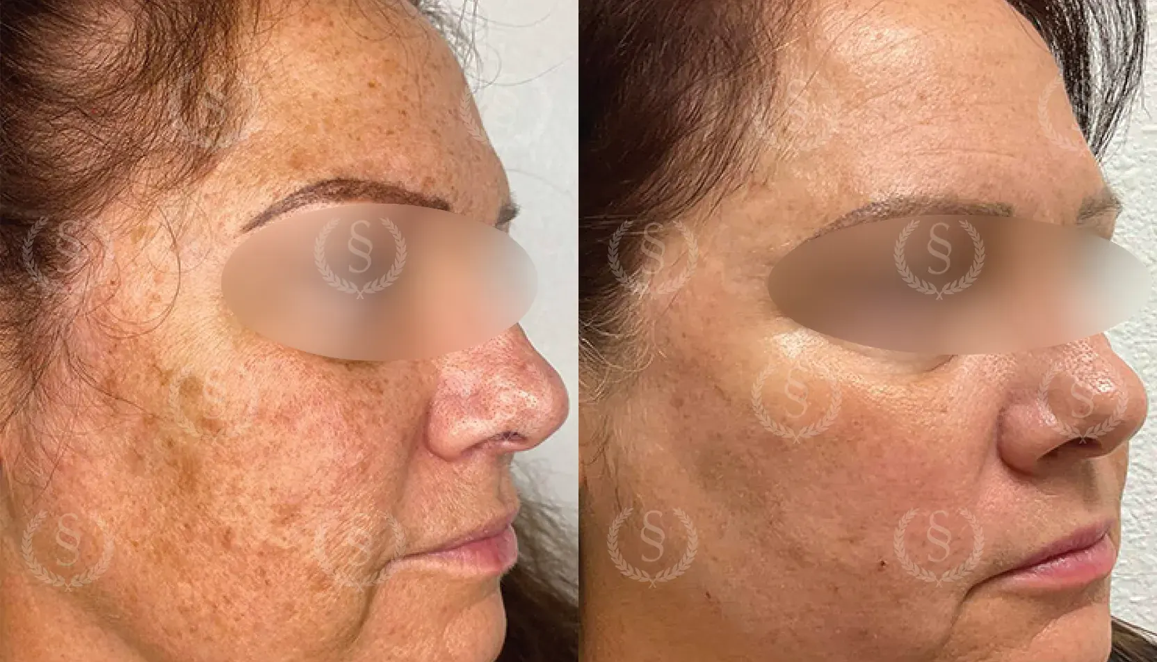 Resultat från behandling av pigmentfläckar på kind och tinning Pigmentfläckar på kind och tinning före och efter behandling