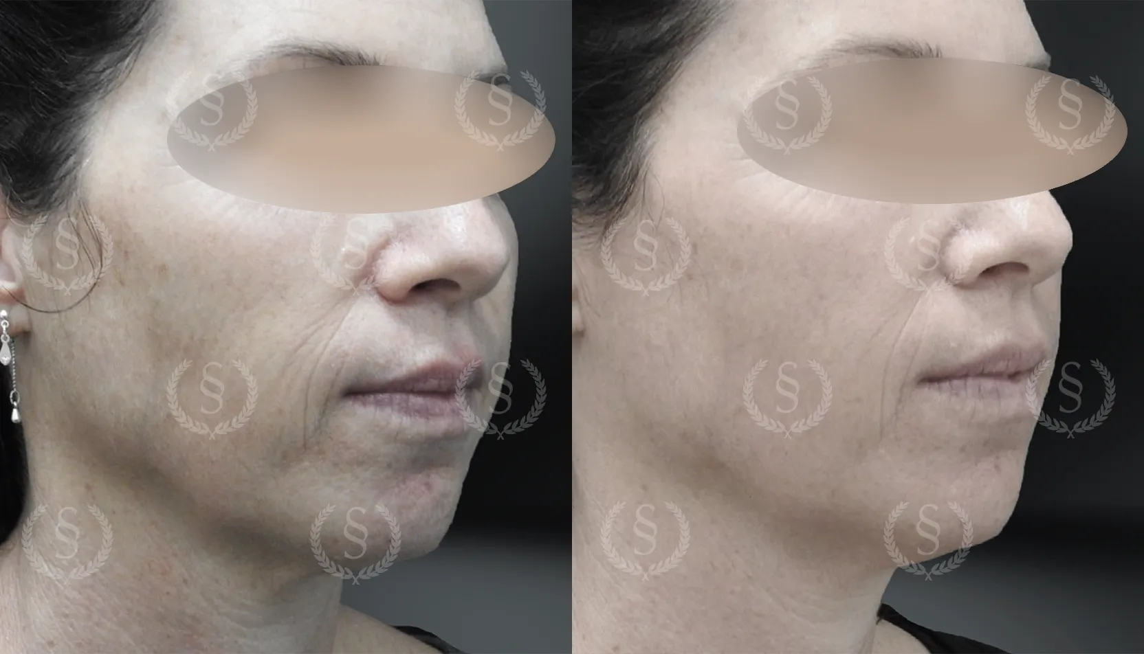 Resultat från behandling av pigmentfläckar på kind Pigmentfläckar på kind före och efter behandling