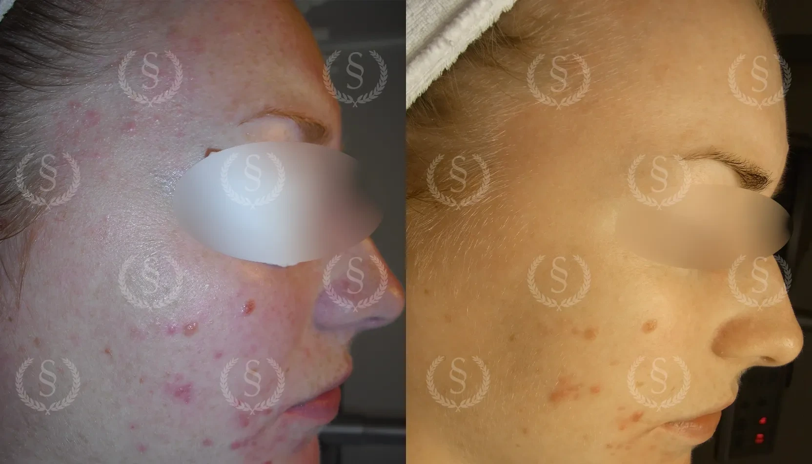 Mycket förstorade porer före och efter behandling