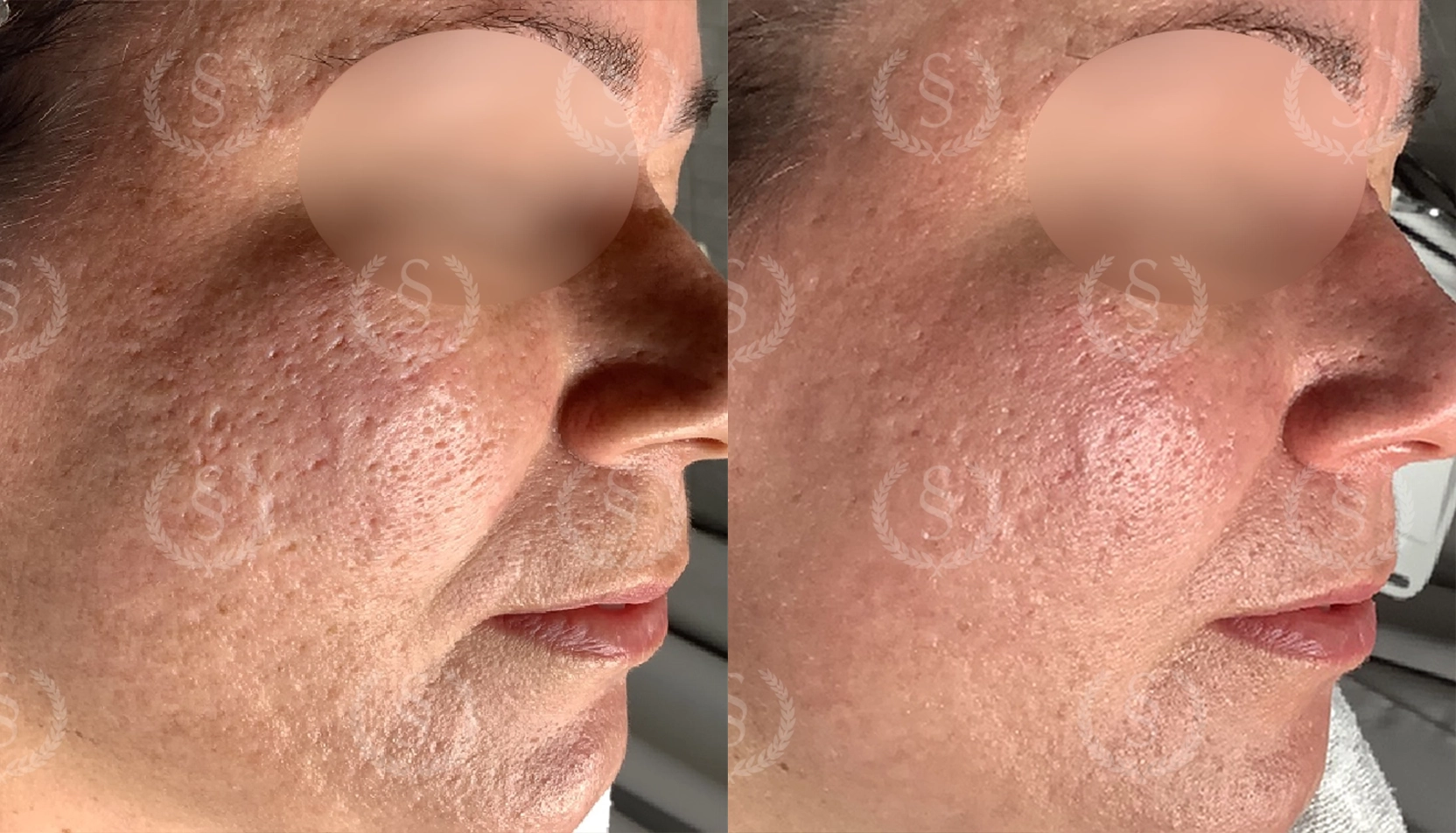 Jämnare hudyta efter laserbehandling Djupa ärr i ansiktet före och efter laser