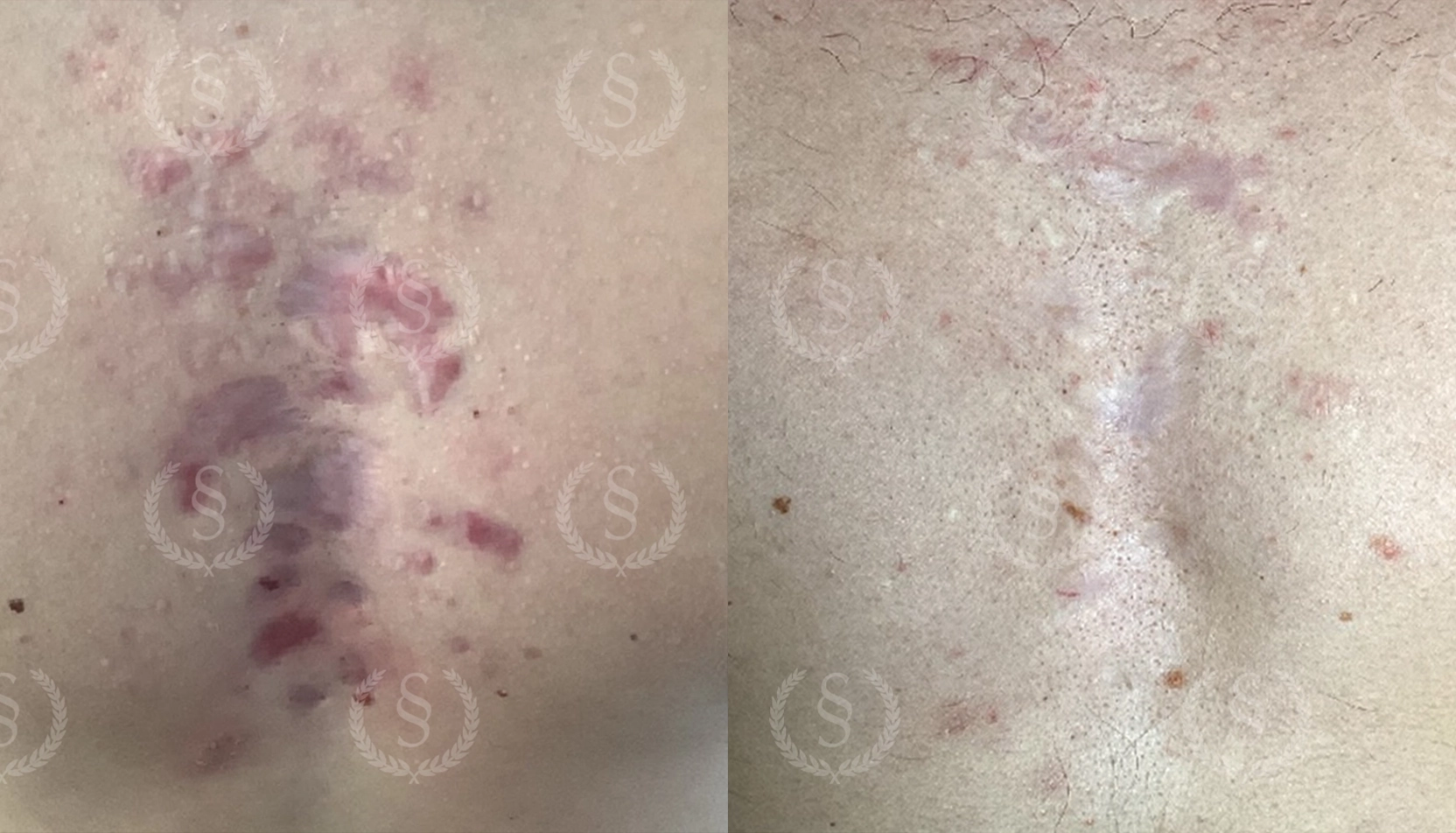 Resultat efter laser mot ärr på bröstet Ärr på bröstet före och efter laserbehandling