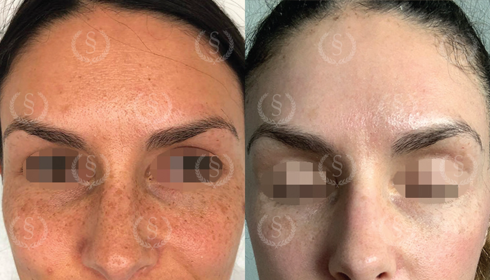 Resultat efter CO2-laser mot pigmenteringar Pigmentfläckar i ansiktet före och efter CO2-laser