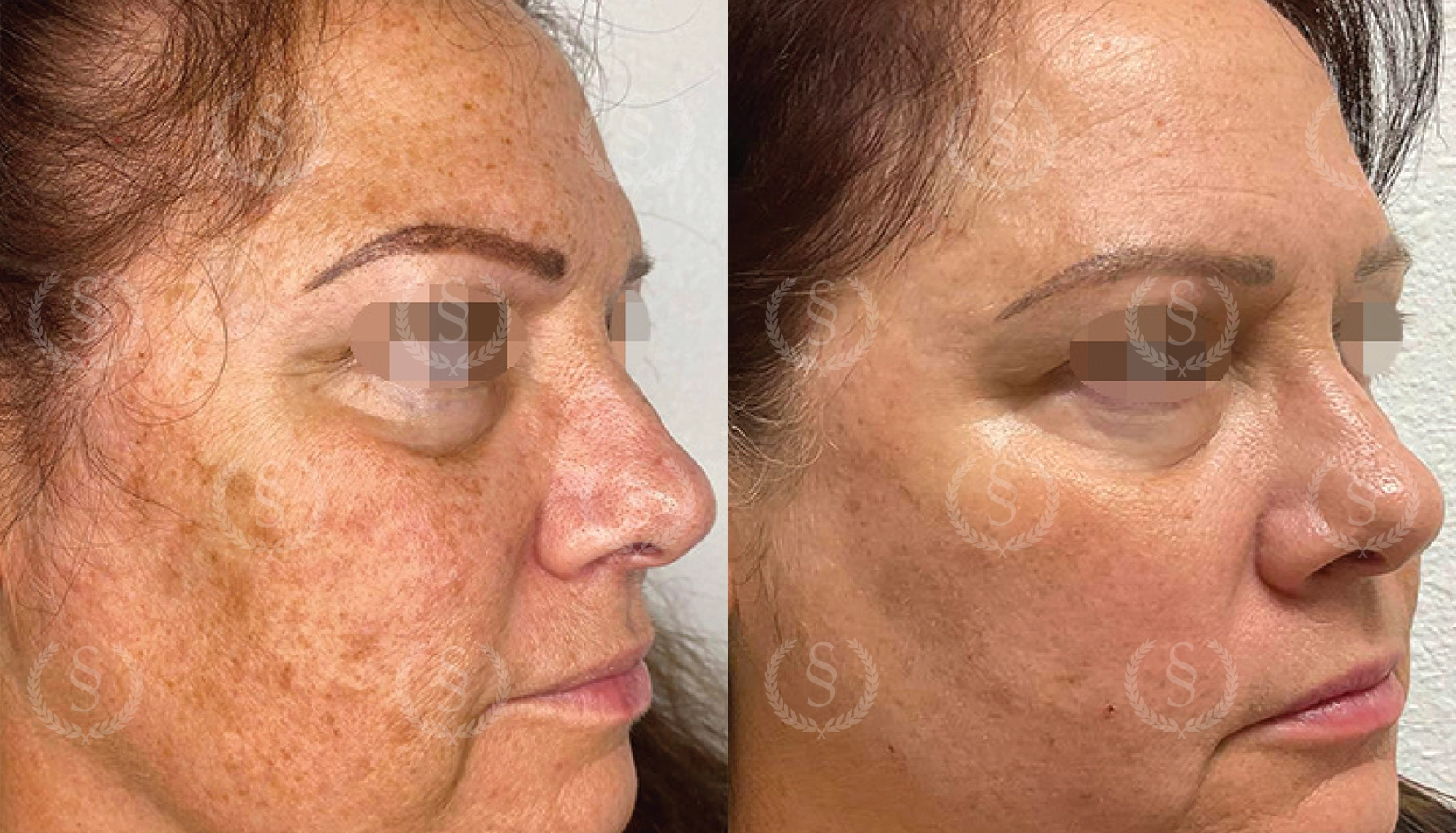 Resultat efter CO2-laser mot pigmenteringar på kinder Pigmenteringar på kinder före och efter CO2-laser