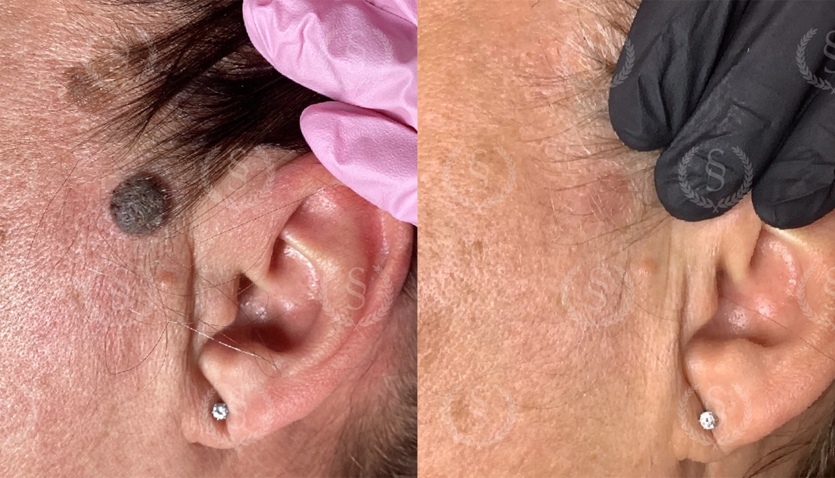 Hudförändring borttagen med CryoPen Hudförändring vid örat före och efter behandling