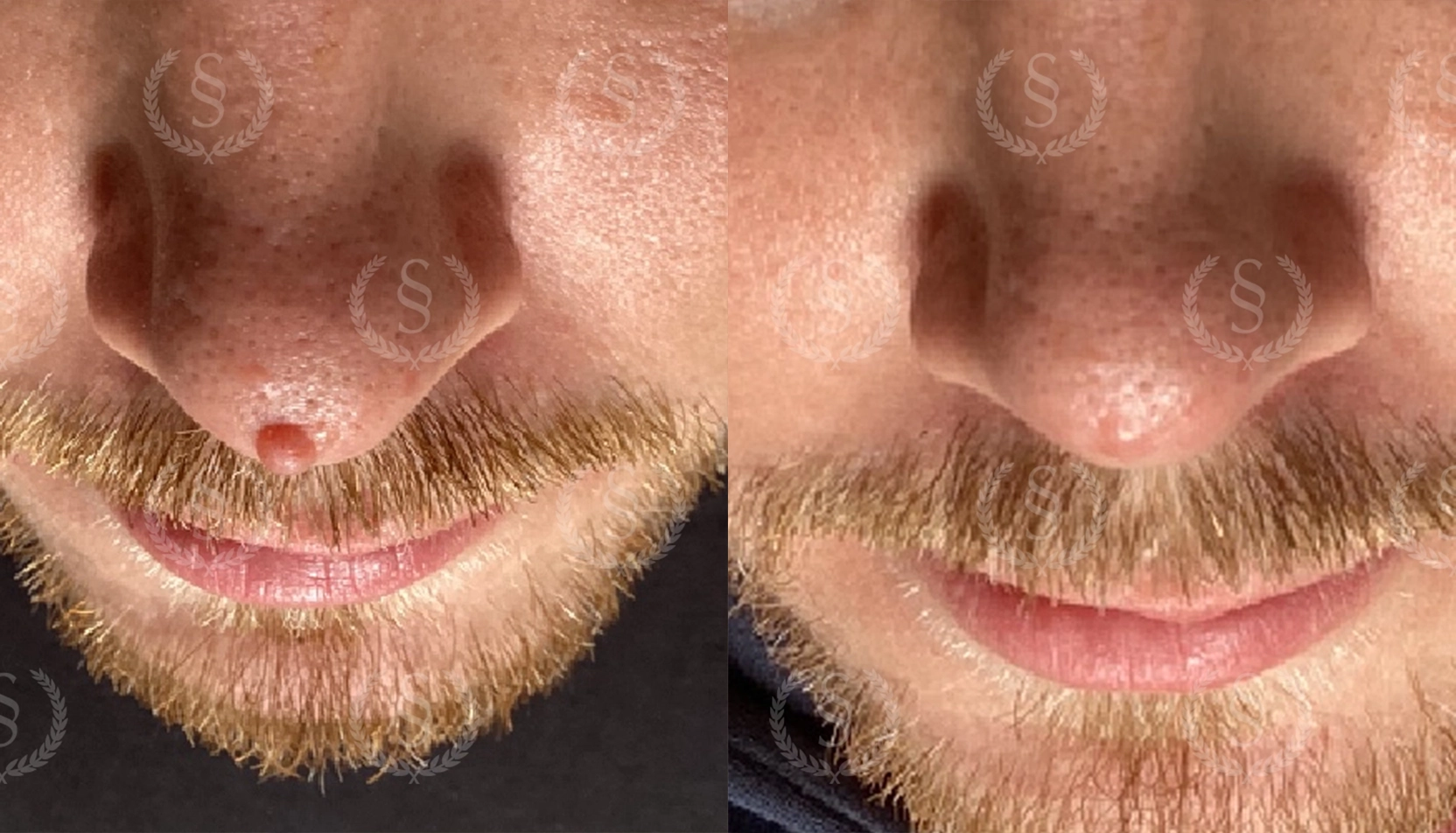 Ren hud efter laser på näsan Hudförändring på näsan före och efter laserbehandling