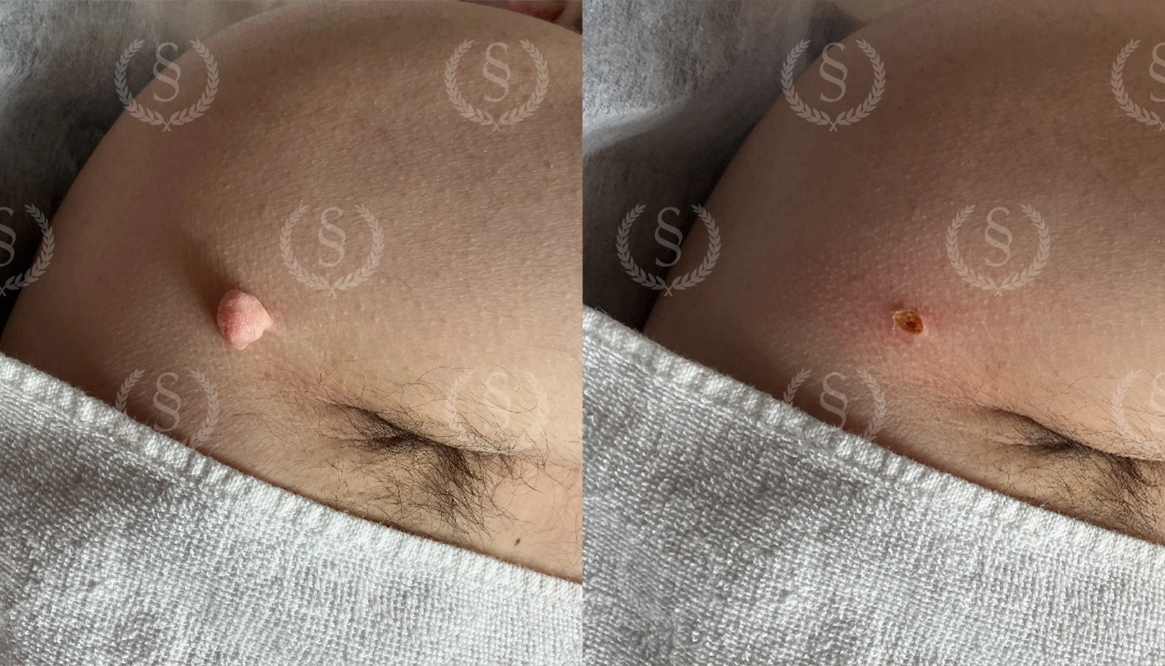 Hudförändring på axeln borttagen med laser Stor hudförändring på axeln före och efter laserbehandling