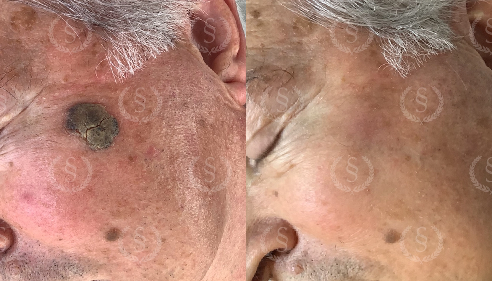 Resultat efter laser mot hudförändring Hudförändring vid tinningen före och efter laserbehandling