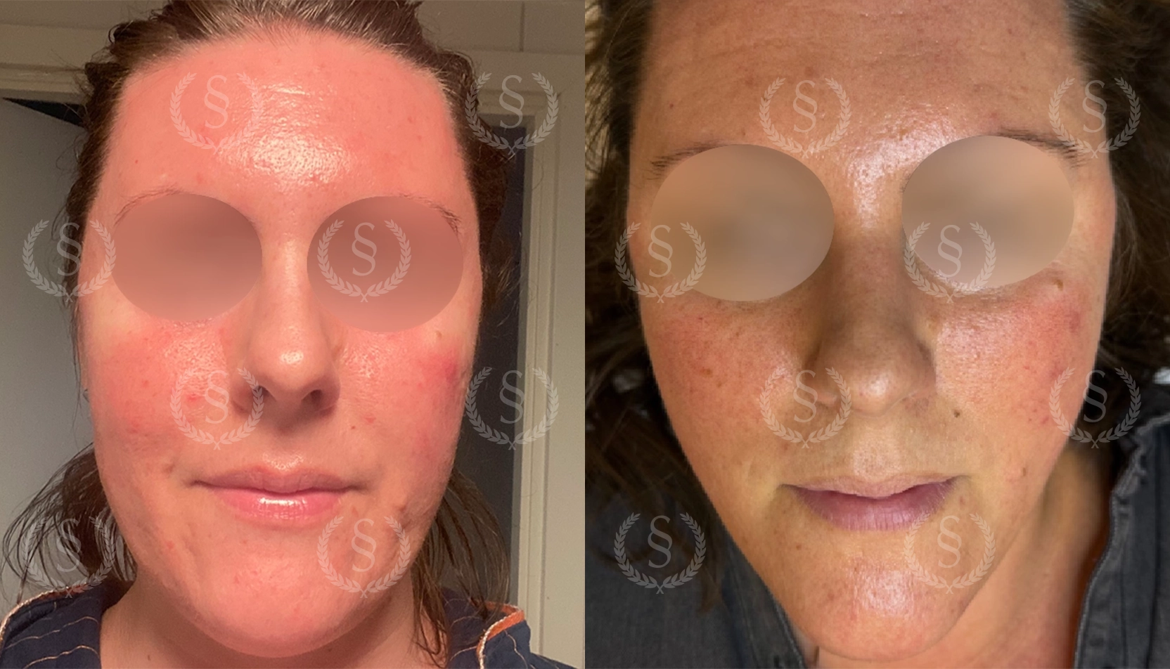 Resultat efter rosacea-behandling Rosacea i ansiktet före och efter IPL-behandling
