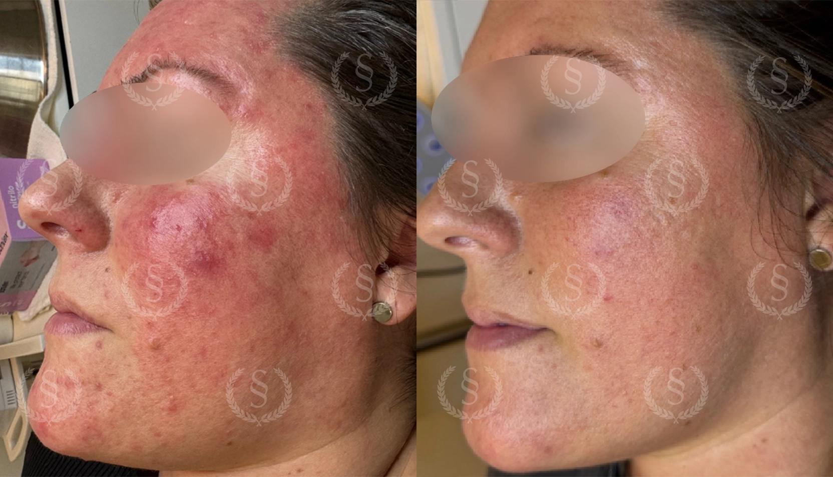 Rosacea-behandling i profil Rosacea från sidan före och efter behandling