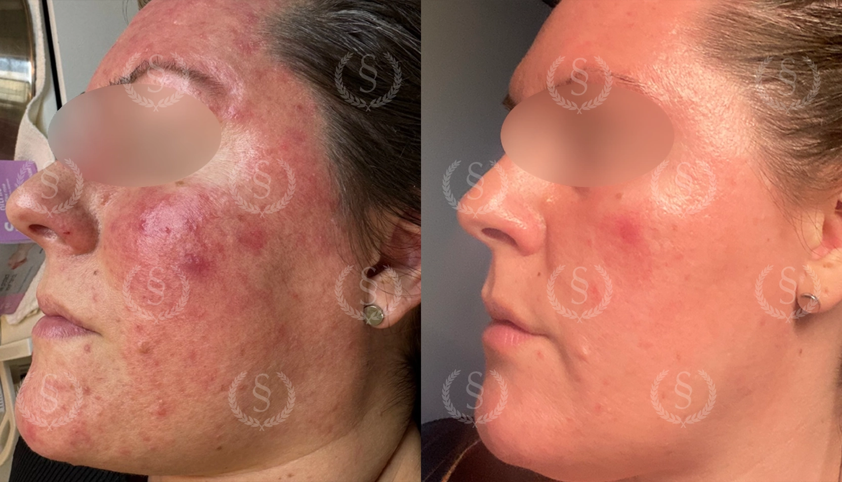 Rosacea från sidan före och efter behandling