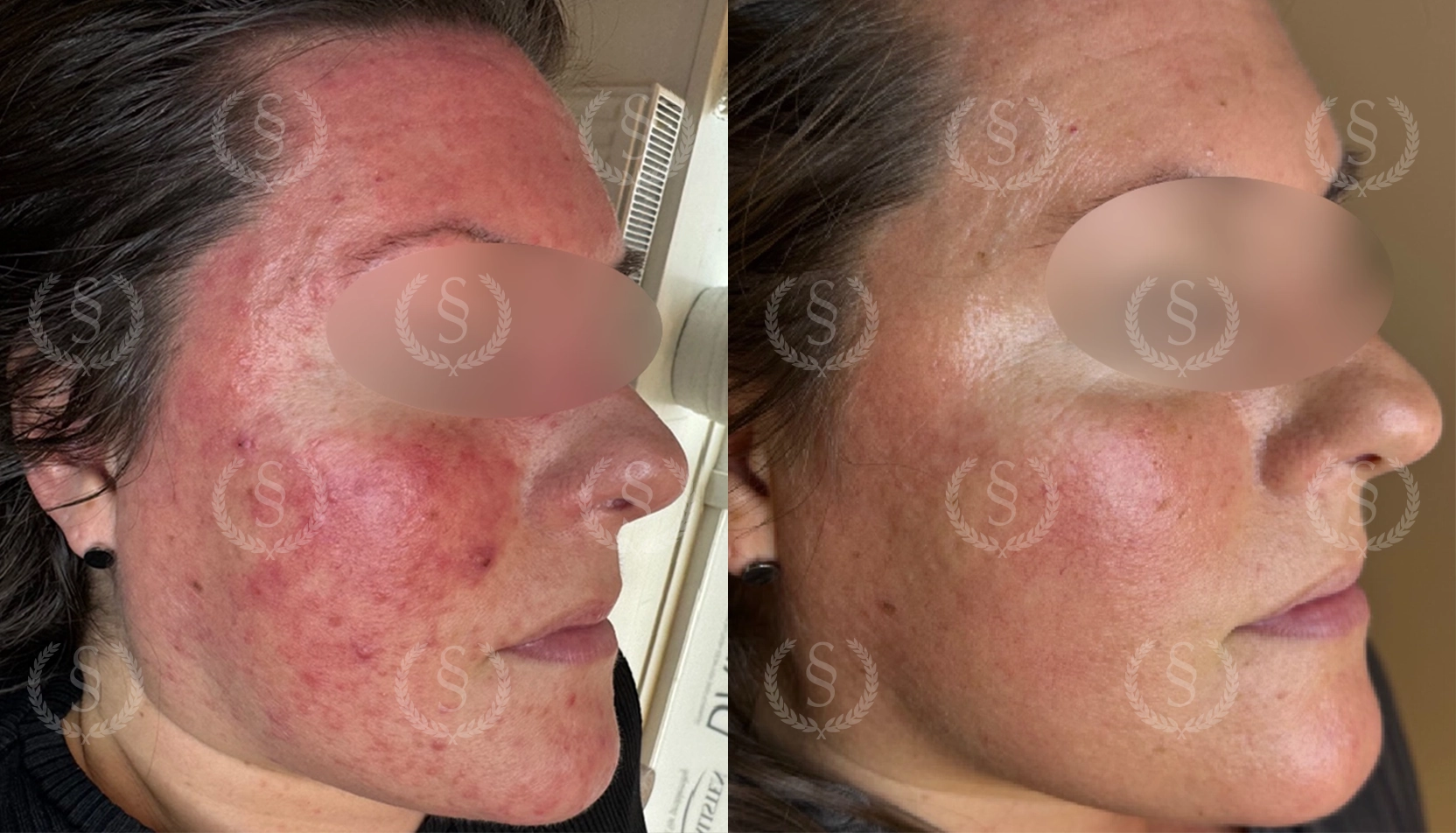 Rosacea-behandling från höger profil Rosacea från höger sida före och efter behandling