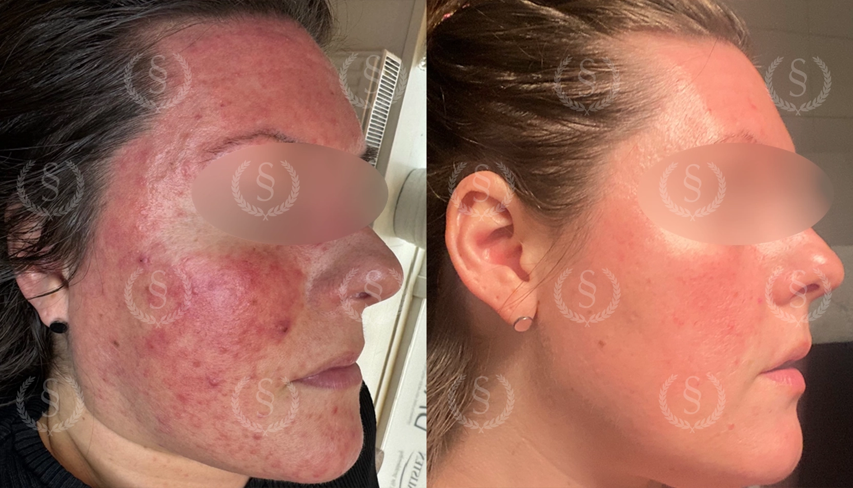 Rosacea från höger sida före och efter behandling