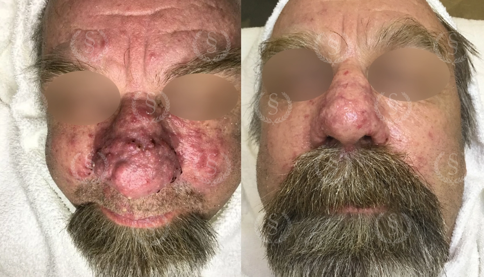 Rhinophyma före och efter behandling