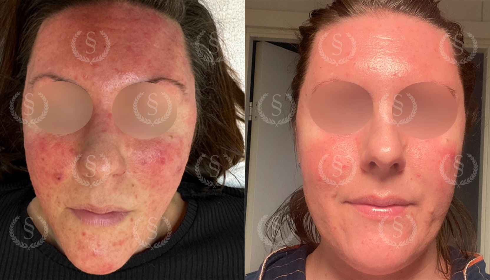 Rosacea i ansiktet före och efter IPL-behandling