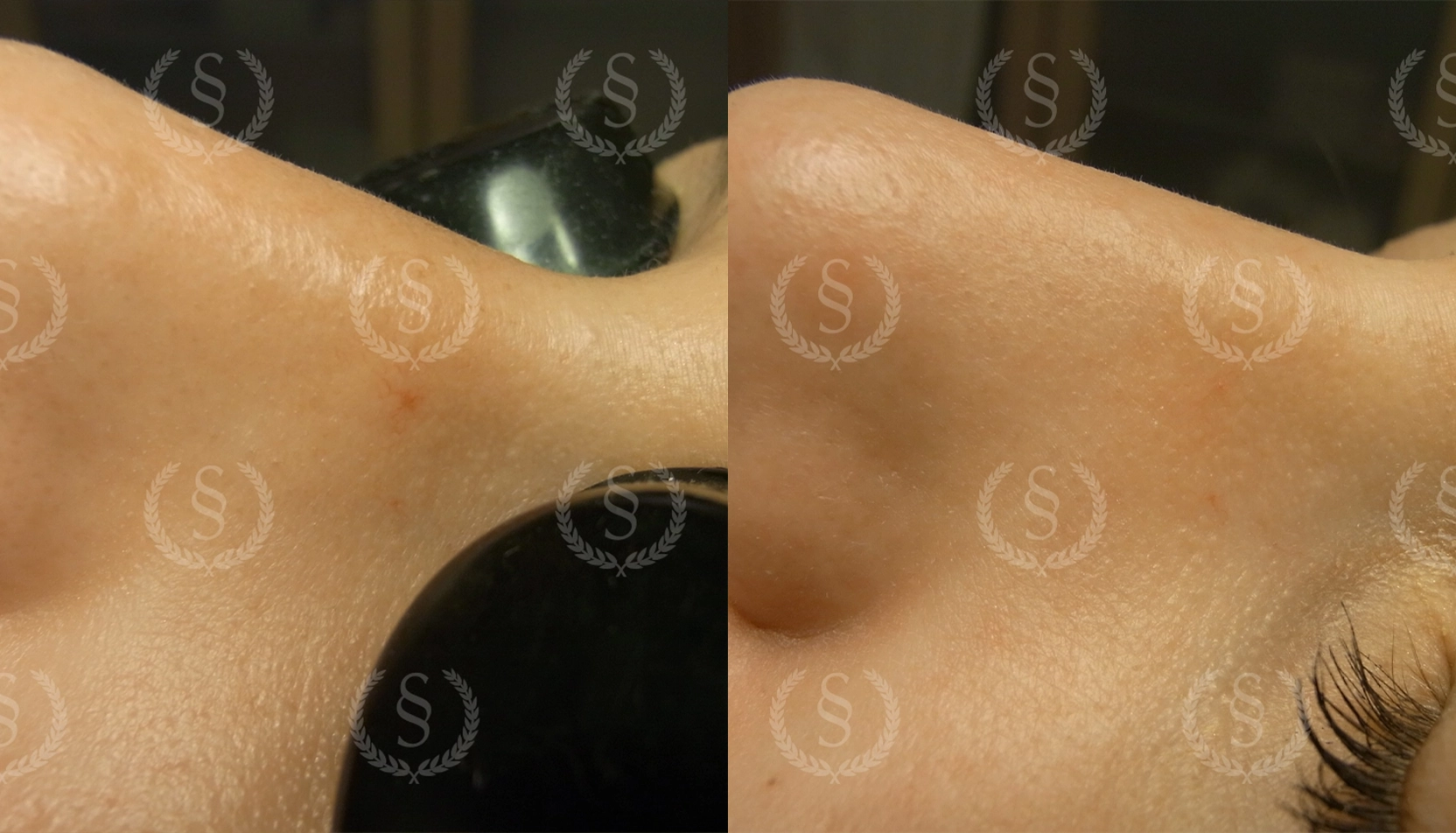 Behandling av spindelkärl med IPL Spindelkärl före och efter behandling