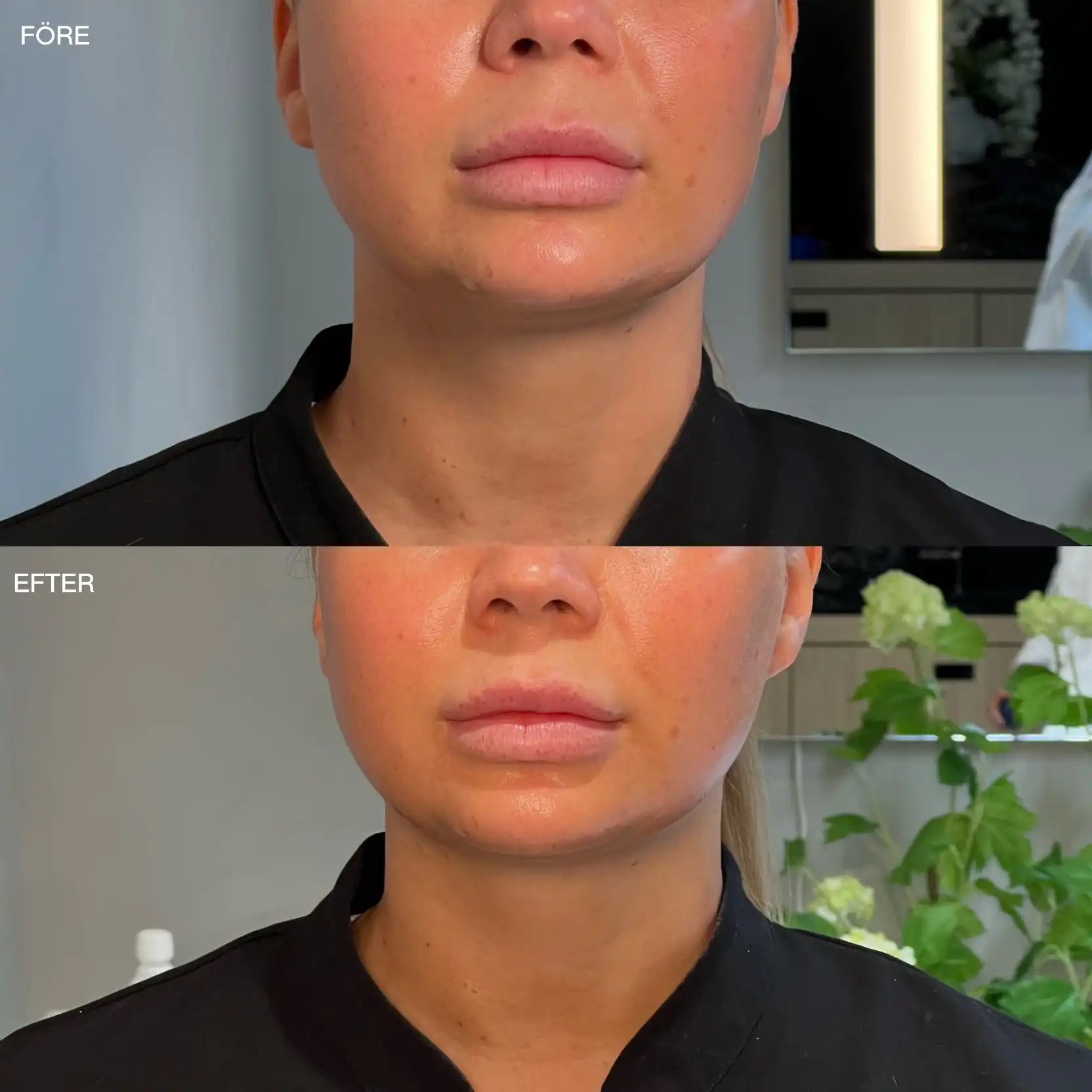 HIFU av hals och käklinje framifrån Hals och käklinje framifrån före och efter HIFU