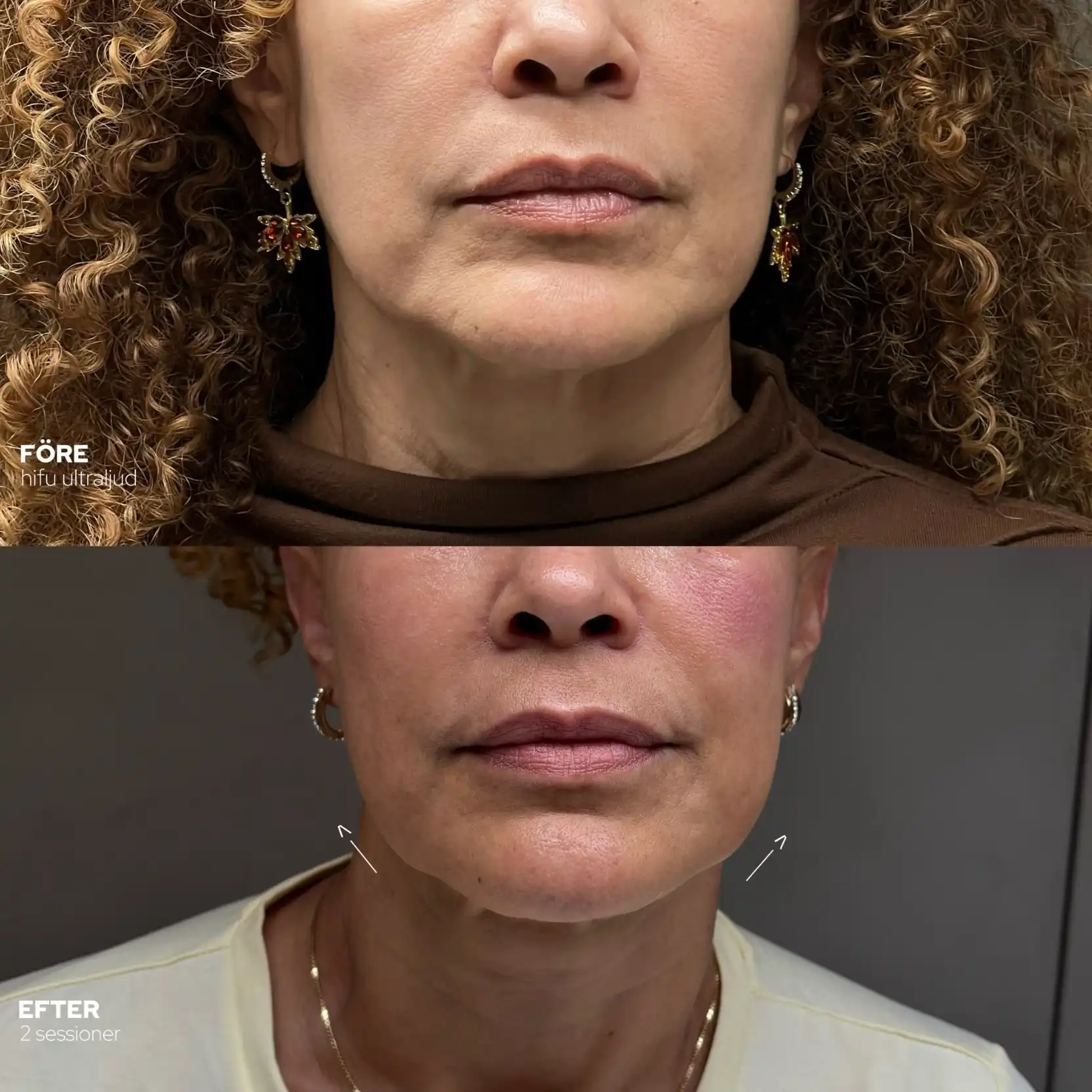 HIFU av käklinje och hals Käklinje och hals före och efter HIFU