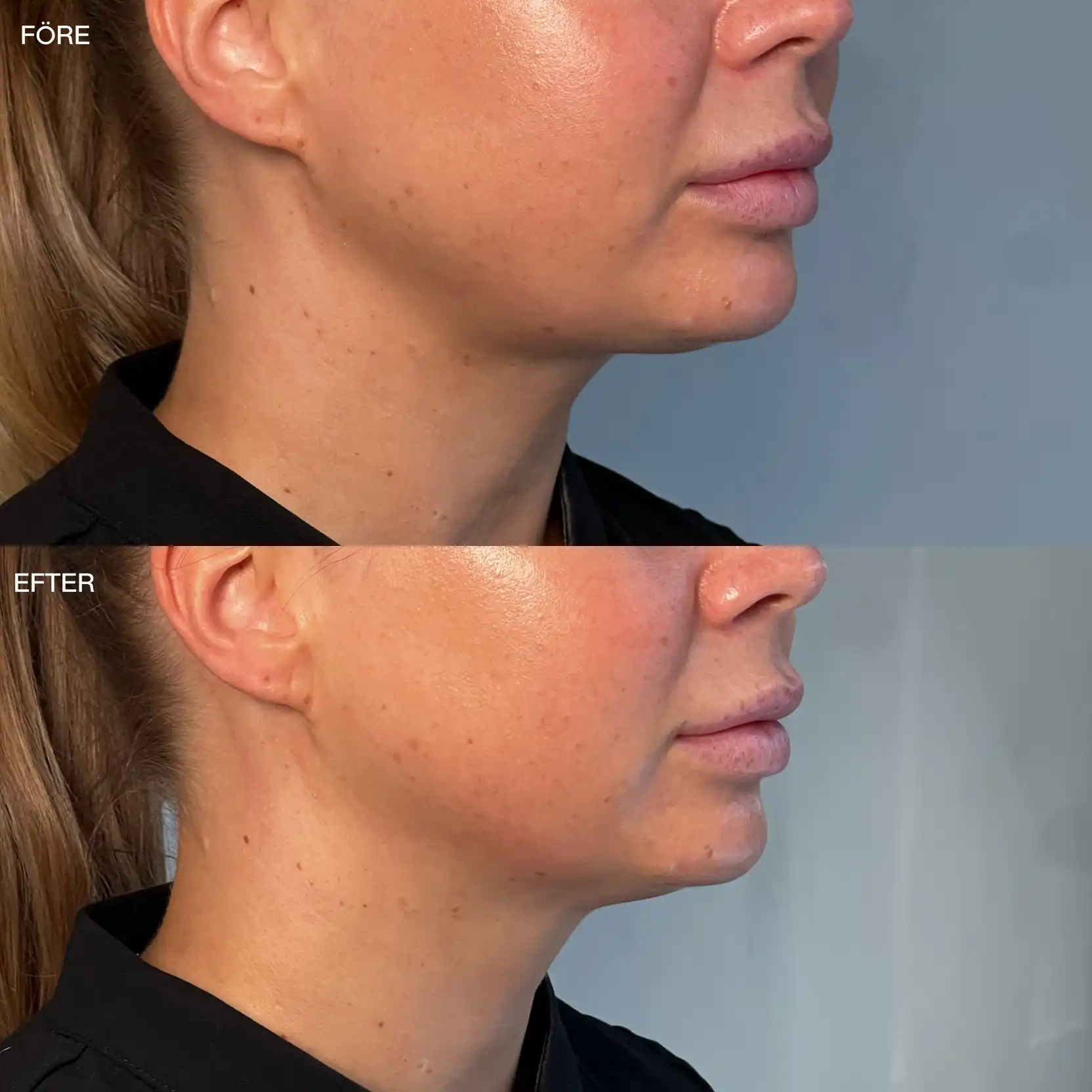 HIFU av käklinje, närbild Närbild på käklinje före och efter HIFU