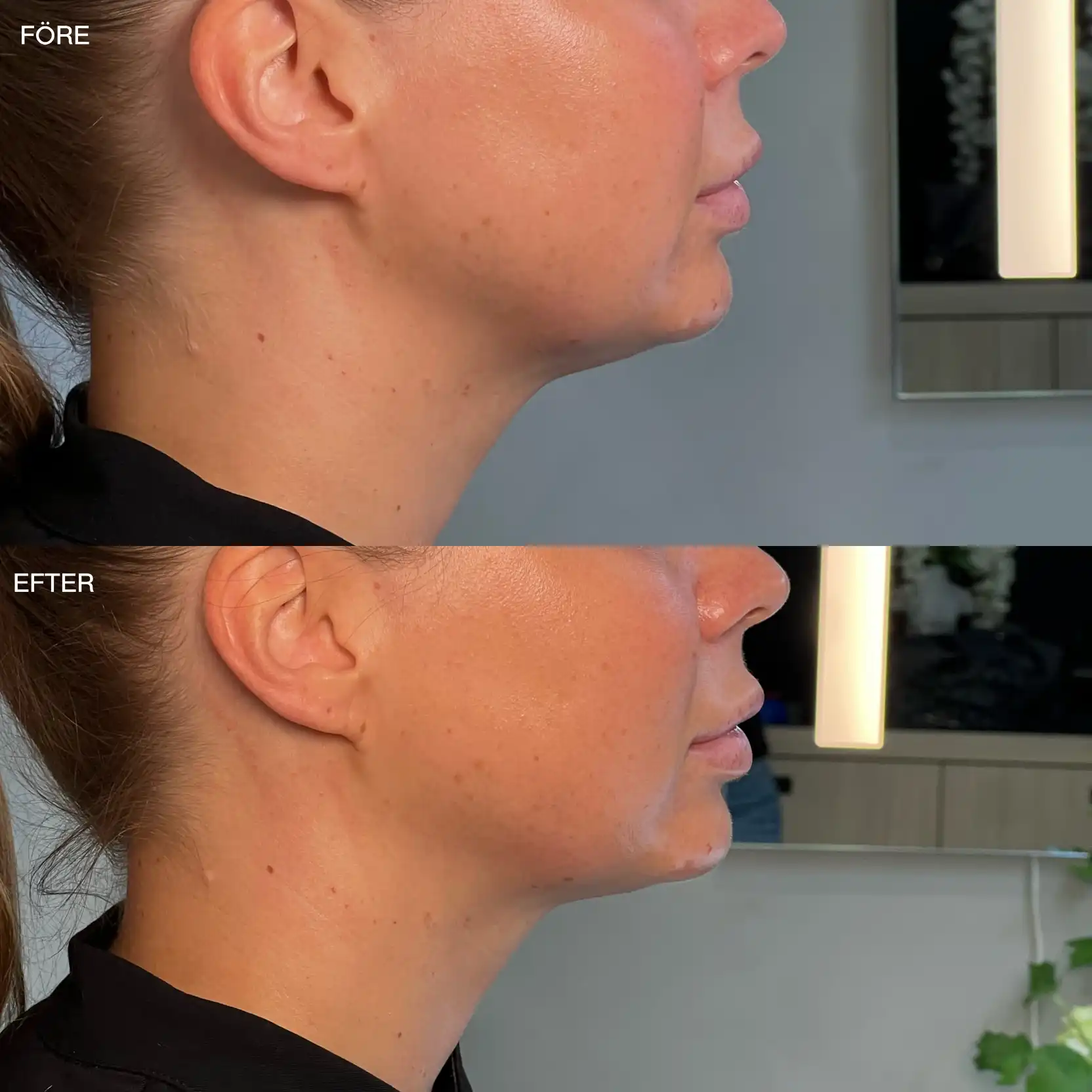 HIFU av käklinje i profil Käklinje i profil före och efter HIFU