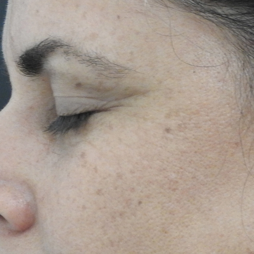 Efter SoftLift-behandling Efter SoftLift-behandling