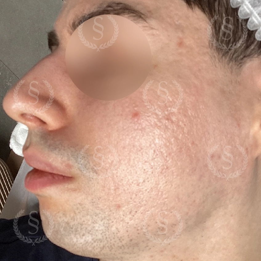 Slätare hud efter laser