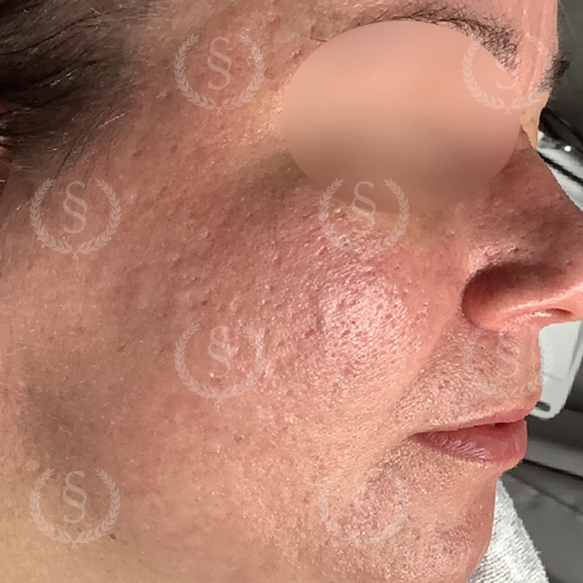 Förbättrad hudkvalitet efter laser