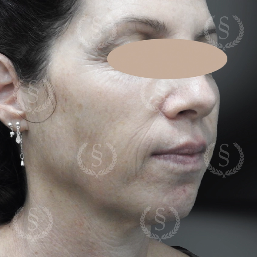 Pigmentfläckar och ojämn hudton före behandling