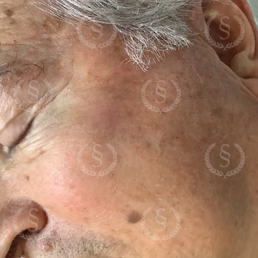 Resultat efter CryoPen-behandling